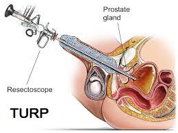 turp-treatment-in-pcmc