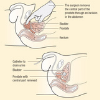 open-prostatectomy