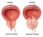 enlarged-prostate