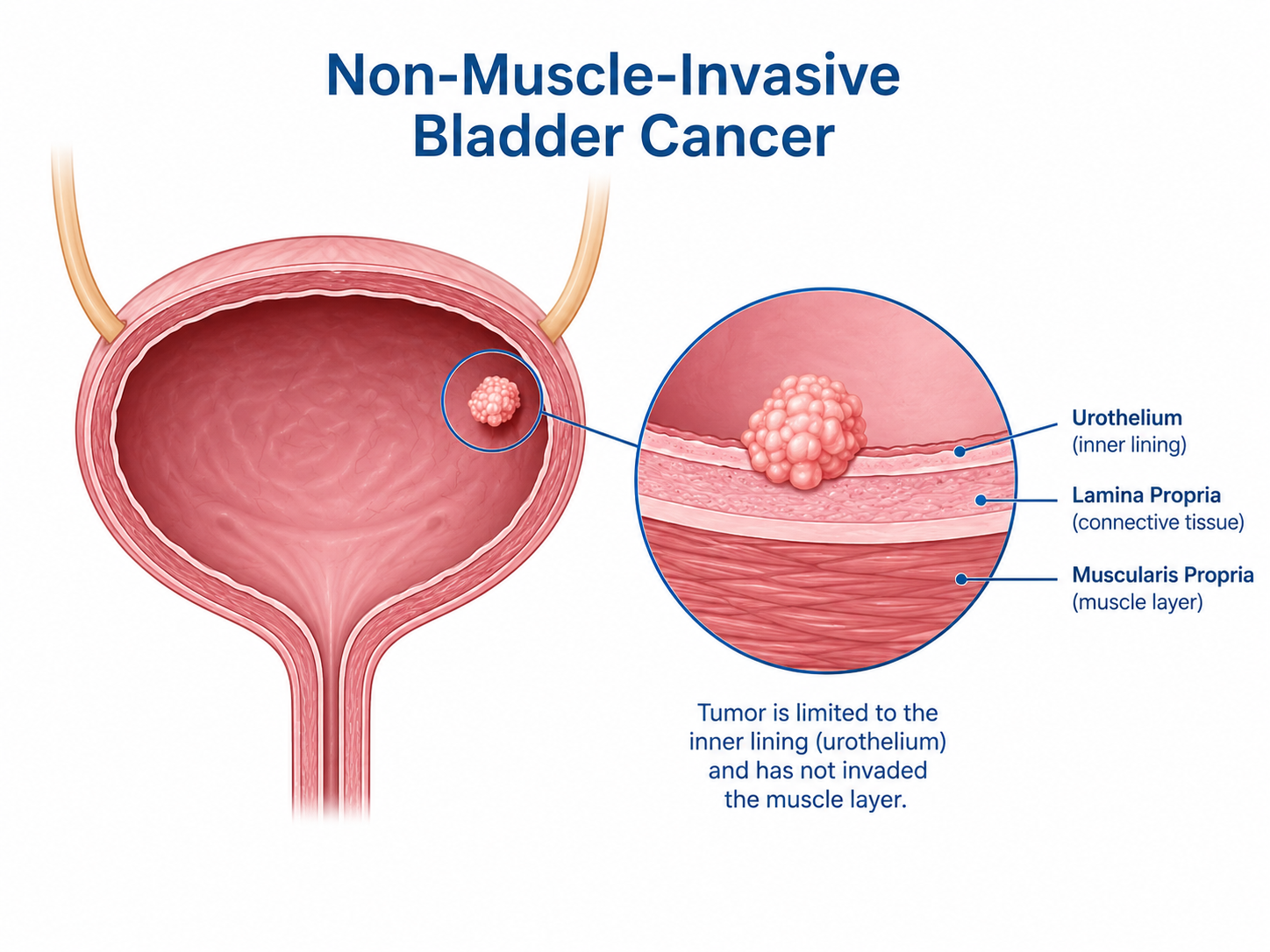 Non-Muscle-Invasive Bladder Cancer