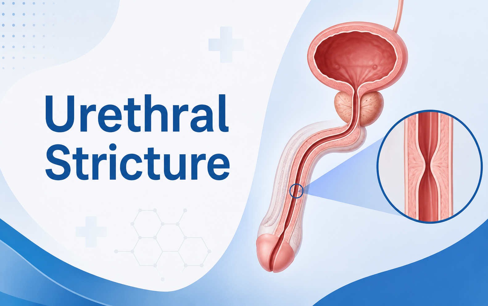 Urethral Stricture