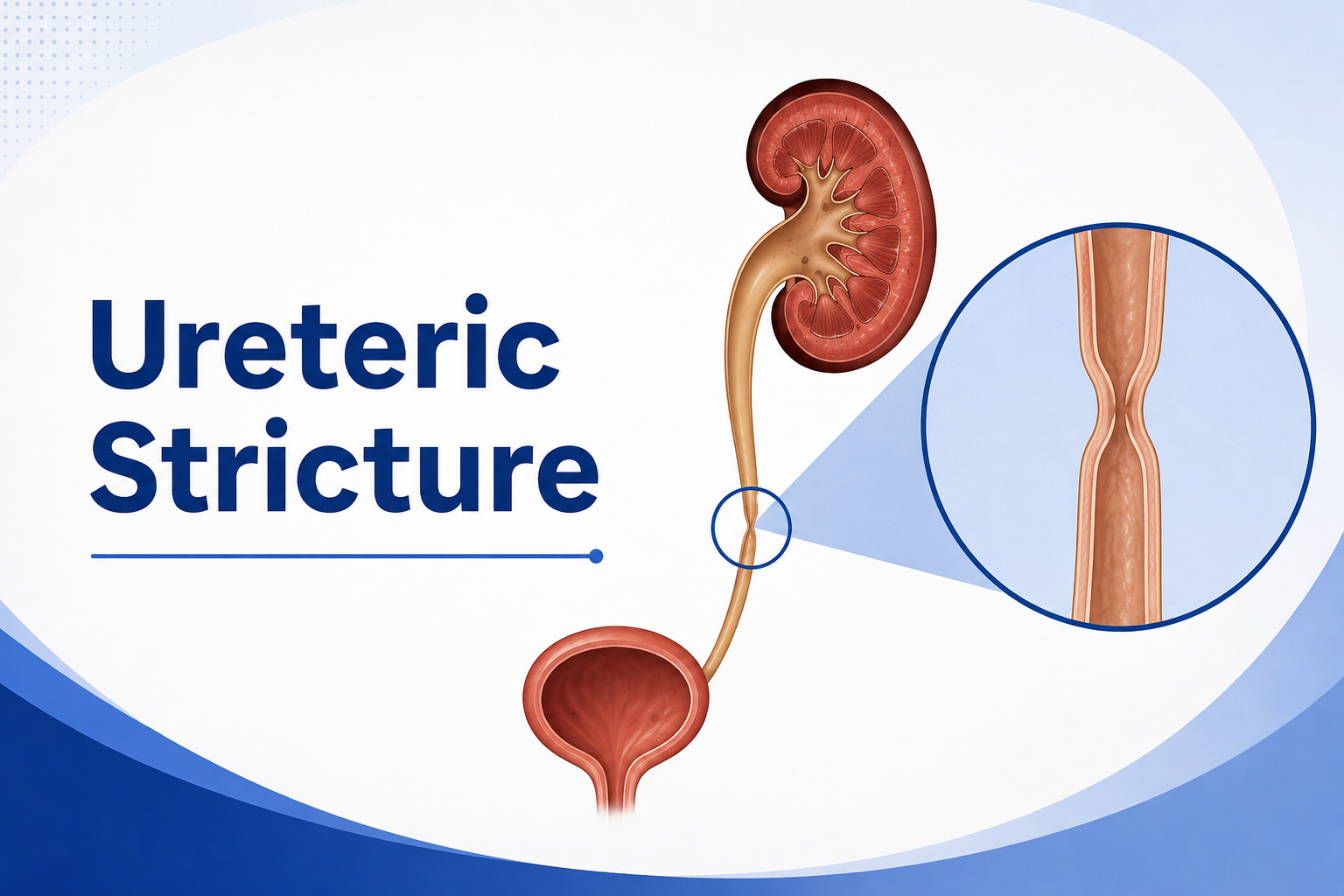 Ureteric Stricture