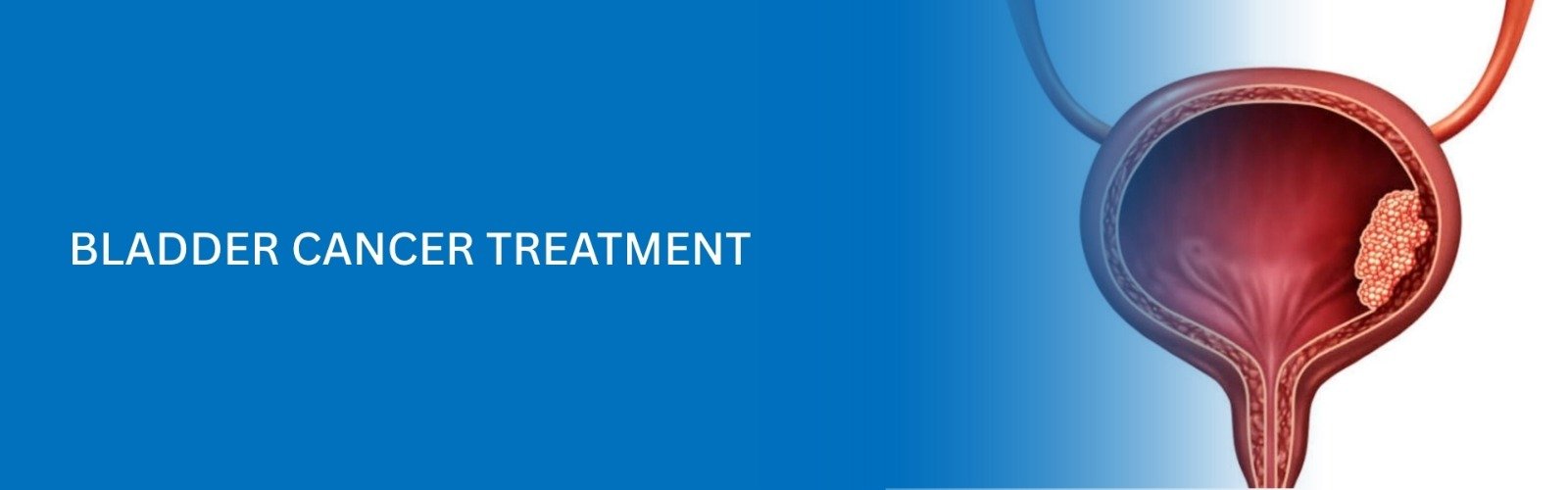 Bladder Cancer Treatment banner